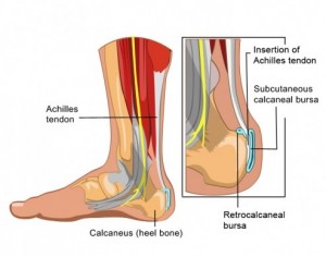 subcutaneous calcaneal bursitis