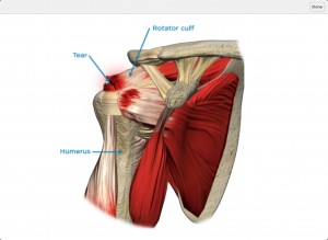 Rotator-Cuff-Injury