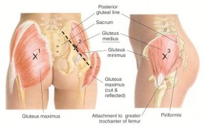 Treatment For Hip Bursitis and Causes Melbourne