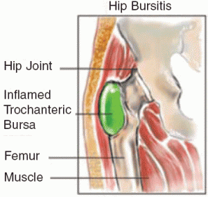 Is Infrared Massage Good for Hip Bursitis?