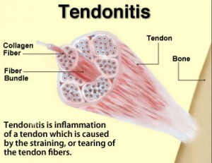 treatment for tendinopathy melbourne