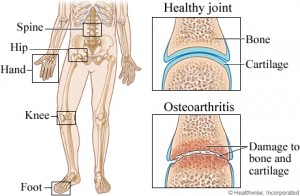 Osteoarthiritis