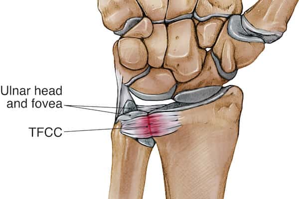 TFCC_injury