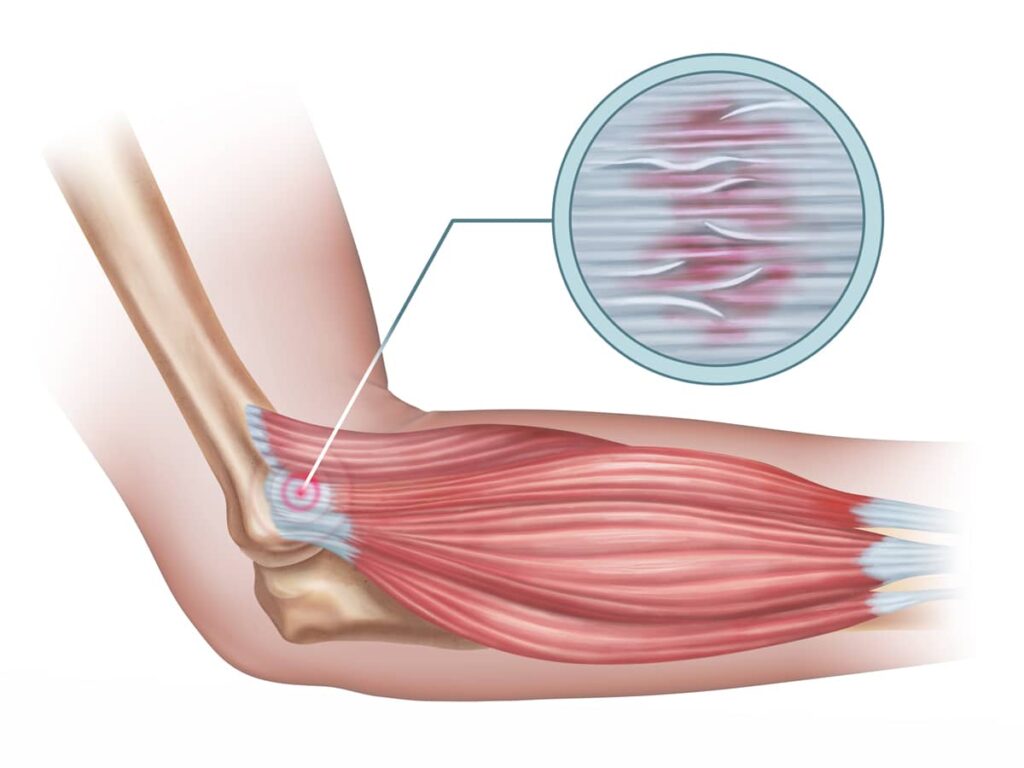 Tendonitis
