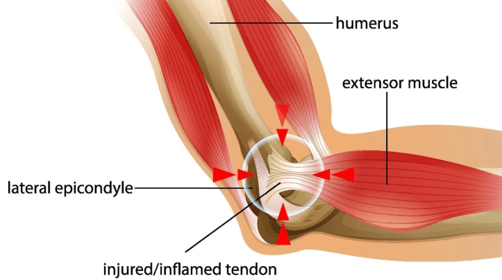 elbow-pain