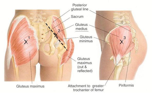 gluteal-tendinopathy