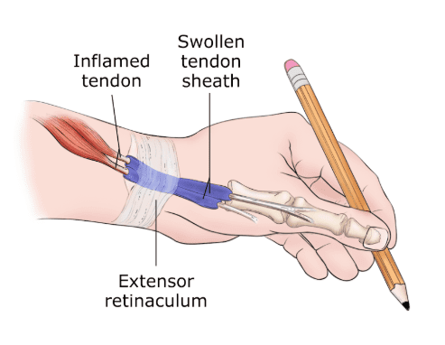 wrist pain